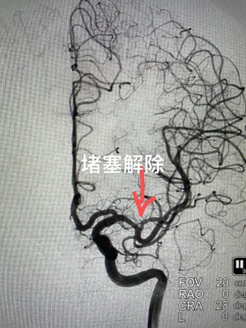 3个月内连发两次脑梗 微米级微创畅通颅内血管